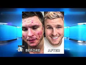 How One Man Defeated His Cystic Acne through Changing What He Ate