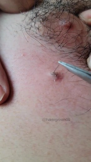 #extraction #blackhead #tweezers #ingrownhairpull #ingrownhair #satisfyingvideo #skincare