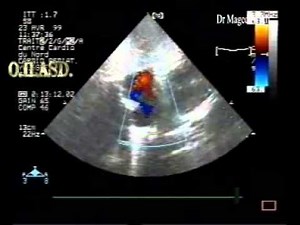 Ostium Secundum Atrial septal defect