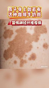 小心！孩子身上有“牛奶咖啡斑”，可能是这种罕见病