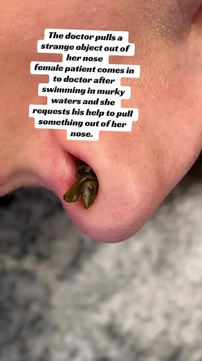Doctor pulls a strange object out of her nose female patient comes in to doctor after swimming in murky waters and she requests his help to pull something out of her nose.#viralvideo #amazing_cute #foryou #money_rain24