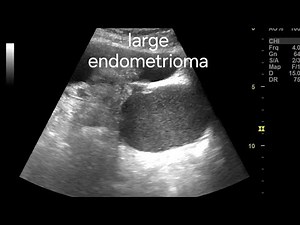 Uterine Fibroids with Large Ovarian Endometrioma: Key Ultrasound & color Doppler Findings, overview