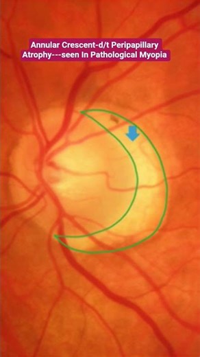 Annular Crescent-d/t Peripapillary Atrophy---seen In Pathological Myopia