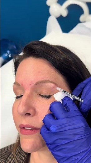 How to Get a Non-Surgical Brow Lift with Botox | Dr. Dahabra’s Secret Technique #shorts