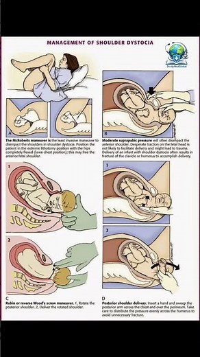 Shoulder Dystocia — All Maneuvers (Single Visual Summary). #studymedglobal