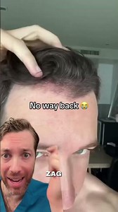 Why a Natural Irregularity Matters in Your Hairline