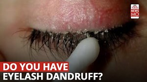 Ever heard of eyelash dandruff?