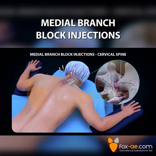 What happens during a pain management procedure, like administering a medial branch block injection? Our animation unveils the mystery by showcasing how a local anesthetic temporarily numbs the painful nerves by being injected near the medial branches of the spinal nerves supplying the facet joints. Whether the pain is in the cervical, thoracic, or lumbar spine, our demonstrative exhibit details every region of the spine to reveal where the injection was administered. Adding this animation to yo