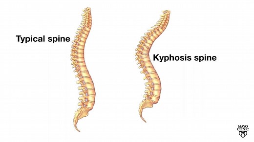 Mayo Clinic Minute: Help with kyphosis, or roundback - Mayo Clinic News Network