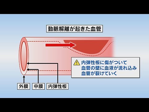 いわて元気○（マル） 【脳動脈解離】（2021/5/18放送 ニュースプラス１いわて）