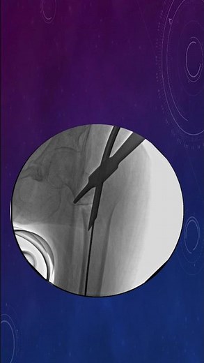 Complex trochanteric fracture nailed in few minutes. #ortho #nailing #trauma #hip #fracture