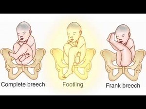 Mechanism of labor: The journey ‪@drrichasaxenaletstalkwoman‬