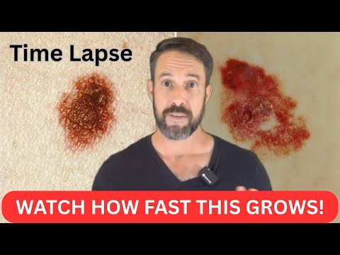 Mole or Melanoma? Can you tell the difference? Life or death ☠️