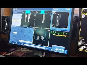 mra lower limb. GE healthcare 3 T signa hero