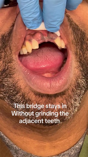 # Bridge No metal only at Issa Dentistry . Call Now