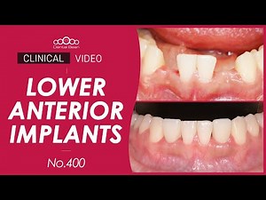 #32, 42 implant placement with bone graft [Dr. Cho Yongseok]