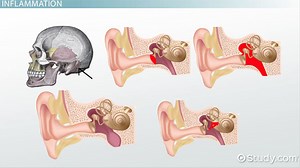 Middle Ear Disorder Terminology - Video | Study.com