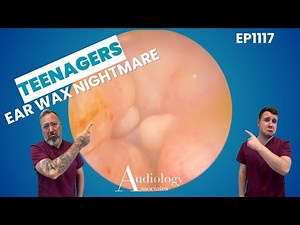 Teen’s Ear Wax Nightmare! Thick, Sticky & Deeply Stuck 😱👂 EP1117
