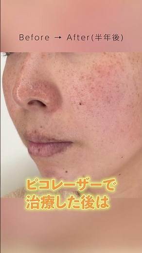 専門医による症例解説【ピコスポット】シミ取り治療 #東京八丁堀皮膚科形成外科 #マナ先生