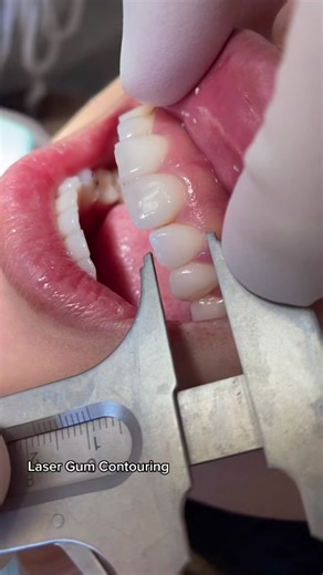 Laser Gum Contouring!!! #dentist #dentistry #veneers #gummysmile #gumlift #teeth #laser #fyp
