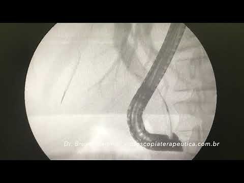 How to perform brush cytology by ERCP?