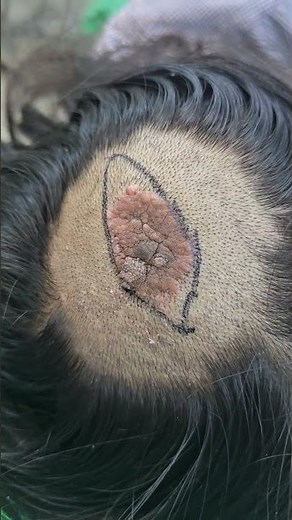 Nevus sebaceous