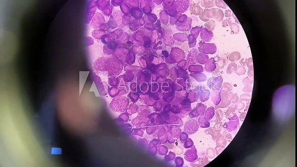 Microscopic footage showing Atypical squamous cells of undetermined significance, it may be a sign of human papillomavirus or yeast infection.