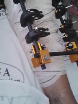 Ilizarov apparatus