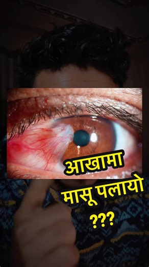 This Eye Growth Is Caused by Sunlight ☀️ Noticed a white or fleshy growth on your eye? It might be pterygium — commonly caused by sunlight, dust, and wind. Early care and UV protection can prevent vision problems. 👁️ Explained by an ophthalmologist. #pterygium #eyedoctor #ophthalmologist #eyehealth #eyecare