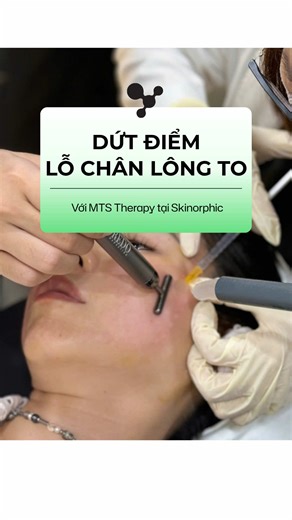 Dứt điểm.lỗ chân lông to với MTS Therapy tại Skinorphic #skinorphic #luciapham #lochanlongto #MTS #mun