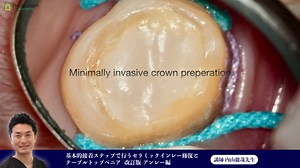 ⑳基本的接着ステップで行うセラミックインレー修復とテーブルトップベニア -改訂版-アンレー編