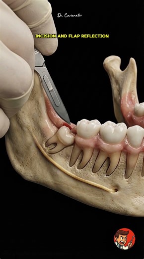 How an Impacted Wisdom Tooth is Removed!