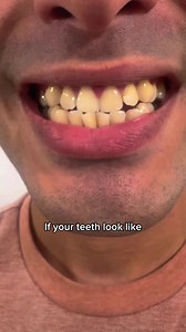 Transform your smile with smileactives® – loved by customers everywhere! 🌟 For a limited time only, buy 1 Pro Whitening Gel & get the 2nd FREE with your introductory order! | smileactives