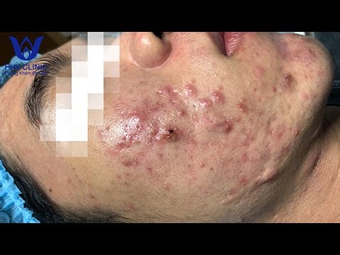 Lấy Nhân Mụn Đầu Đen, Mụn Viêm, Mụn Đầu Trắng - Relax Every Day With | HHV CLINIC | Hiền Vân Spa #37