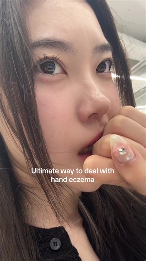 Dealing with Hand Eczema: Tips and Tricks