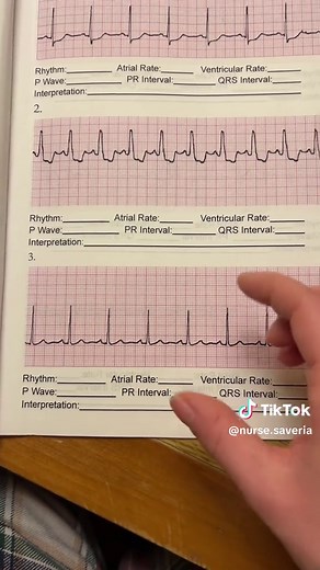 Understanding Normal Sinus Rhythm (NSR) on ECG