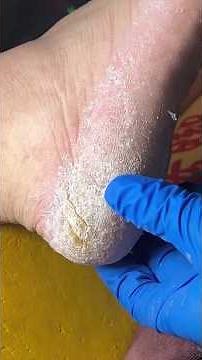 Heel Callus Removal | Step-by-Step Foot Care Transformation. #satisfyingvideo #gentlecare #asmr