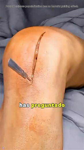 Torn ACL Repair Surgery Explained (3D Animation)#aclrepair #tornacl #kneesurgery#medical3d #3d