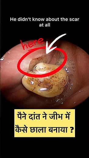 Sharp lone tooth causing tongue ulcer #tongue #ulcer #sharptooth