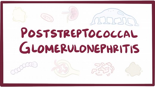 Poststreptococcal glomerulonephritis: Video, Causes, & Meaning | Osmosis