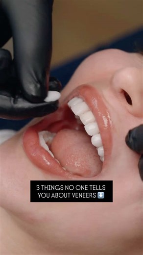 3 things no one tells you about veneers 👇 1️⃣ We don’t shave your teeth down to stumps anymore. In most cases, we’re able to preserve a large amount of your natural enamel. Our approach is always conservative — we remove as little tooth structure as possible. 2️⃣ They don’t look fake. Cosmetic dentistry has come a long way. Today’s porcelain and techniques allow us to create smiles that look natural, balanced, and uniquely yours — not “veneers.” 3️⃣ They aren’t out of reach. We offer in-office 