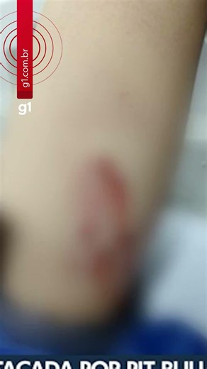 Menino de 10 anos é atacado por pit bull e precisa passar por cirurgia #g1 #shorts