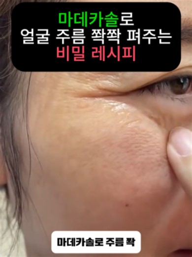 🌍마데카솔로 얼굴 주름 쫙쫙 펴주는 비밀 레시피 바로 공개합니다😊 🧴 마데카솔은 그냥 바르는 게 아니라 라리타크림이랑 같이 써야 깊은주름 관리에 효과 좋다고 하네요. ✨ 사용하는 방법은 정말 간단합니다 세안 후 먼저 라리타크림을 얼굴 전체에 얇게 발라주세요. 💡 그 다음 팔자처럼 깊게 접힌 부분에만 마데카솔겔을 소량 덧발라주면 끝입니다. ⚠️ 여기서 중요한 건 마데카솔은 꼭 겔 타입 사용하기. 연고형이나 복합 제품은 피부 관리용으로는 맞지 않는다고 합니다. 🫧 라리타크림이 깊어진 주름에 필요한 콜라겐 · 엘라스틴 · 수분을 꽉 채워주고 🌿 마데카솔겔이 주름 부위를 한 번 더 감싸주면서 집중적으로 관리해주는 방식이라 자고 일어나면 깊게 패여 있던 주름도 쫙 펴진 느낌이라는 후기 정말 많다고 하네요 ✨ 🛒 라리타크림은 쿠팡 · 네이버에서 구매 가능합니다 💛 #건강 #주름 #피부 #마데카솔
