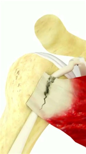 Shoulder Clicking? It Might Be Biceps Instability!