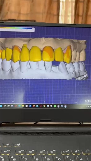 Proceso en exocad diseño de sonrisa #vyral #fypシ #parati #escudent #dentistas #zirconia