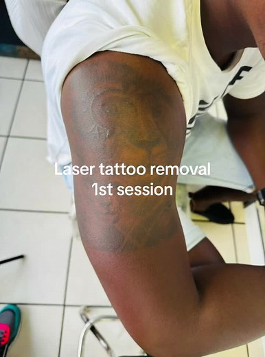 Laser Tattoo Removal: 1st Session Process Explained