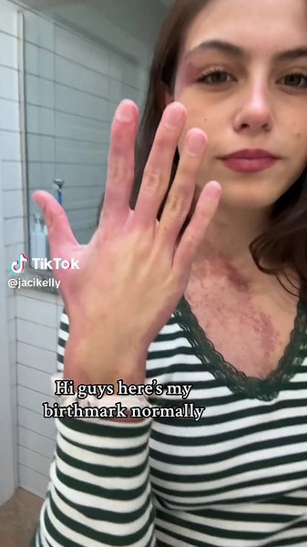 Understanding Port Wine Stain Birthmarks