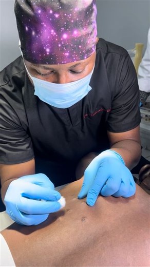 Dr. Foladavid MD, PhD.H on Instagram: "Steatocystoma multiplex (SM) is an uncommon disorder of the pilosebaceous unit. It is also a benign condition. In most patients, it may have psychosocial implications resulting from the disfigurement due to widespread lesions. The prognosis for patients with steatocystoma multiplex is excellent. In this video we are carrying out carbon dioxide laser ablation for the multiple lesions, this offers a low percentage of recurrence and good aesthetic results #ste