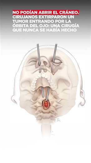 No podían abrir el cráneo. Cirujanos extirparon un tumor entrando por la órbita del ojo: una cirugía que nunca se había hecho. | Primeros Auxilios | Badabun