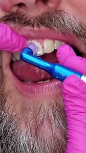 Stain removal before & after. Vera for the win with the ultimate combo ➡️ stain removal prophy paste and our splatter guard prophy angle with external ridges for more effective stain removal! 🏆🏆🏆 #youngdental #rdh #dentalhygiene #dentalhygienist #dentistry #dentallife #dentistryworld #rdhlife #dentalhygienelife #futurerdh #dentalhygienestudent #rdhstudent #dentalassistant #dentalassistantlife #dentalassistants #prophy #prophylaxis #prophypaste #verapaste #prophyangle #veradpas #splatterguard 